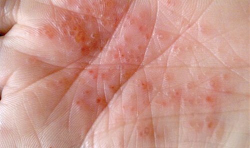 赤い発疹は梅毒の初期症状